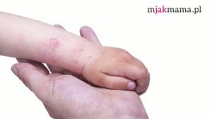 Atopowe zapalenie skóry u dzieci - diagnostyka i leczenie